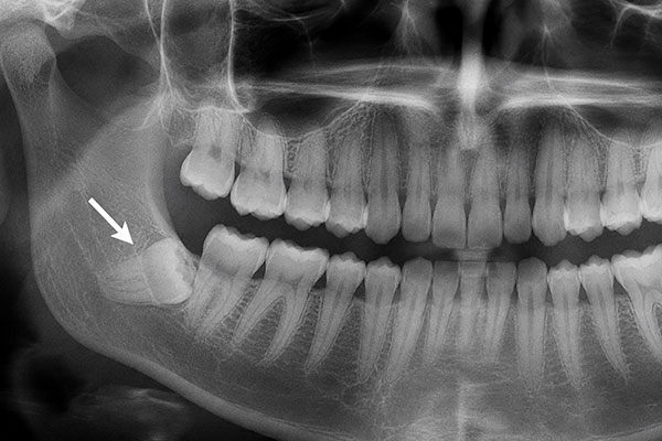 Wisdom teeth